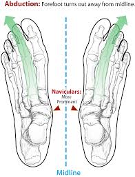 The net result is the extensor digiti minimi remains unopposed, with the abduction positioning favored. Cascade Dafo