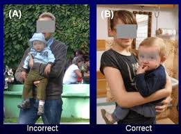 Poland syndrome is a condition that is present at birth where there is a problem with muscle development that affects one side of a child's body. Syndrome Of Contractures And Deformities According Prof Hans Mau Symptoms Diagnosis Treatment Recommendations For Parents