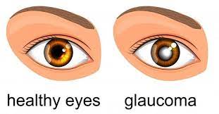 | meaning, pronunciation, translations and examples. Glaucoma Symptoms Treatment And Prevention Royal Spanish Center
