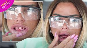 Yes, i'm taking it …though the price is rather high… anyway. Katie Price Dribbles As She Unveils Bloody Real Teeth In Graphic Clip From Dental Clinic Mirror Online