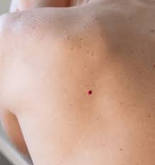 This method before using home remedies for cherry angiomas, you should talk with your healthcare provider. Hhmh 8lou9ldlm