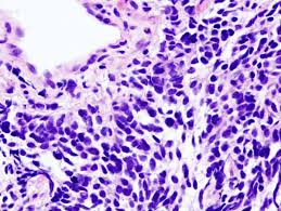 Sebaceous carcinoma, sebaceous gland adenocarcinoma, carcinoma of sebaceous gland. Carcinoma Definition Types Explanation And Quiz Biology Dictionary