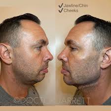 Neck Lift & Décolleté