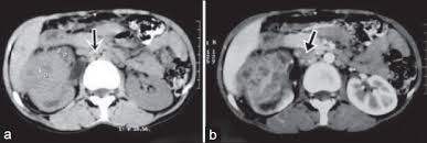 Image result for Genitourinary Tuberculosis