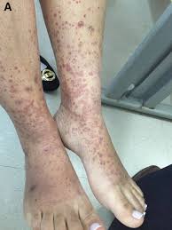 The spots are caused by bleeding underneath the skin secondary to platelet disorders, vascular disorders, coagulation disorders, or other causes. An Unusual Cause Of Skin Rash In Crohn S Disease Gastroenterology