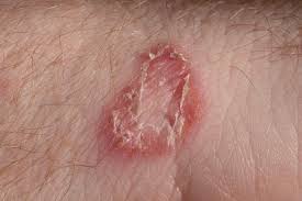 Does hand sanitizer kill ringworm : Ringworm Treatment Symptoms And Pictures