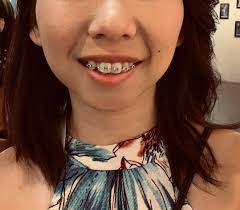 Tips to reduce braces pain. Finally A Brace Face At 23 A Little Embarrassed But Can T Wait For Straight Teeth Braces