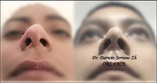 Dr. Darwin Serrano Otorrinolaringólogo