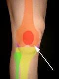 Ursache von knieschmerzen kreuzbandriss meniskusriss anatomie des kniegelenks selbstdiagnose und.knieschmerzen?! Knieschmerzen Auf Der Innenseite Was Steckt Dahinter