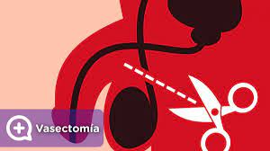 Se trata de un método anticonceptivo permanente, ya que impide la salida de los espermatozoides con el eyaculado y, por tanto, el embarazo. La Vasectomia Como Metodo Anticonceptivo Seguro Mediquo