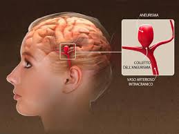 • nell'emorragia cerebrale un vaso sanguigno si rompe. Quanto E Pericoloso L Aneurisma Cerebrale Corriere It