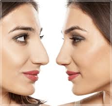 However, you shouldn't just pick one at random. Rhinoplasty Missoula Mt Nose Job Montana Center For Facial Plastic Surgery
