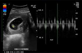 There are different types of doppler ultrasound, but all use the doppler effect (an increase or decrease in wavelength) to measure sound waves that reflect off of moving. Ultrasound In Puerto Vallarta Your Ultrasound Scan At Cmq Hospitals