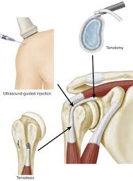 Image result for Biceps Tendon Injection