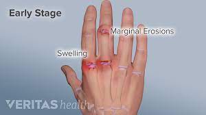 Hand Pain And Rheumatoid Arthritis Ra
