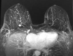 If you are at risk of getting a certain disease, your caregiver may want to do an mri to look for signs of the disease. Breast Mri Department Of Radiology