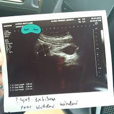 Namun bila si kecil batuk disertai demam atau ia menjadi lebih rewel, pertimbangkan untuk memberikan obat berikut meski demikian, madu hanya disarankan untuk diberikan pada anak di atas usia 1 tahun. Kena Cyst Berulang Kali Wanita Ini Kongsikan 5 Makanan Ini Patut Dielakkan Pa Ma