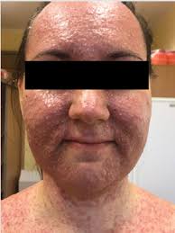 Long-Term Response to Afatinib in Lung Adenocarcinoma Harboring Compound  Uncommon EGFR Mutations: Case Report