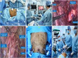 A total of 1540 patients were included (950 mckeown, 590 ivor lewis). Total Minimally Invasive Mckeown Esophagectomy In An Esophageal Cancer Patient With Situs Inversus Totalis A Case Report Xie 2021 Thoracic Cancer Wiley Online Library