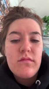 Panoxyl saved my life fr #fyp #foryoupage #panoxyl