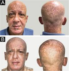 Image result for Diffuse Hyperpigmentation