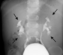 Image result for Voiding Cystourethrogram
