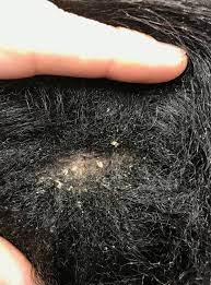 This makes the hair more susceptible to breaking. Afro Scalp Cleansing Remove The Itchy Dry Flaky Scalp