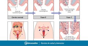 El cáncer y tu vida amorosa. Clasificacion Y Pronostico Del Cancer De Cuello De Utero
