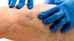 The most common form of venous thrombosis is a deep vein thrombosis (dvt), when a blood clot forms in the deep veins of the leg. Trombosis Venosa Aprende A Detectar Esta Grave Enfermedad Notiboom
