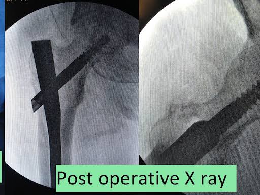 Nailing- Intertrochanteric fracture product image