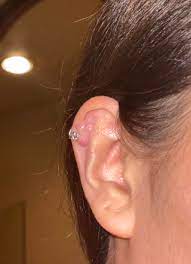 Help Please Is This A Keloid On My Cartilage Piercing Had It Pierced For A Few Years Now And The Bump Keeps Growing What Do I Do Piercing
