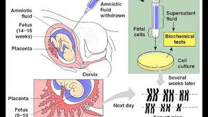 Image result for Chorionic Villus Sampling