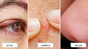 Anjali, milia on the face are usually formed spontaneously, and there are a number of factors that contribute. Eyelid Bumps 101 How To Identify Styes Milia Pimples Allure