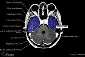 Cross Sectional Anatomy Of The Brain Interventional Radiology Mri Brain