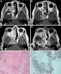 Aspergillosis is one of the most prevalent mycosis. Aspergillosis Eosinophilic Esophagitis And Allergic Rhinitis In Signal Transducer And Activator Of Transcription 3 Haploinsufficiency Journal Of Allergy And Clinical Immunology