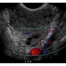 Check spelling or type a new query. Pelvic Ultrasound 5 31 13 Unremarkable Scan Picture Showing Normal Download Scientific Diagram