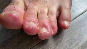 Choi explains that these symptoms haven't been widespread so far. Covid Toes Could Skin Conditions Offer Coronavirus Clues Abc News