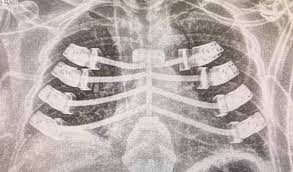 Rib cage human rib cage n. Patient Receives A 3d Printed Rib Cage Implant 3dnatives