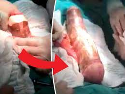 WATCH: 18ins homemade sex toy surgically removed from man's anus - Daily  Star