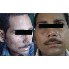 Pritesh Sheth, Author at Indian Journal of Dermatology, Venereology and  Leprology