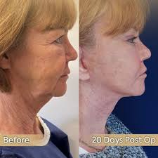 Neck lift in Turkey