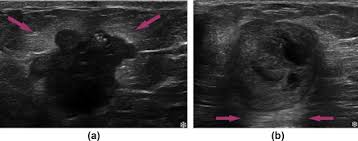 Breast cancer in men just looks like breast cancer in women. Associations Between The Ultrasound Features Of Invasive Breast Cancer And Breast Cancer Specific Survival Clinical Radiology