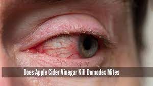 Does Apple Cider Vinegar Kill Demodex Mites on Humans?