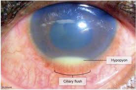 Image result for Ciliary Flush