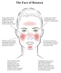 The Many Faces Of Rosacea Acne Rosacea Rosacea Treatment
