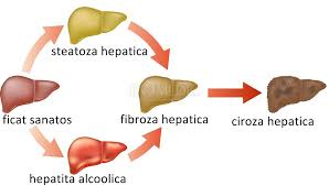 Ficatul poate avea de suferit din cauza unei infecţii virale (cu virus hepatitic a, b, c, d, e), dar şi din cauza unui stil de viaţă nesănătos: Cum Tratam Ficatul Gras Cu Sfecla Rosie SÄƒnÄƒtatea Ficatului È™i Vezicii Biliare