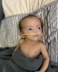 Happy Gastroschisis Day to all in the no belly button club 💚 Here's a  condensed version of JR's journey—for those curious or facing something  similar. Early in my pregnancy, bloodwork flagged high