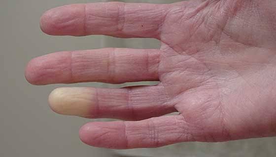 raynaud disease ile ilgili görsel sonucu"