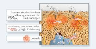Ein atopisches ekzem, auch neurodermitis oder atopische dermatitis genannt, ist eine chronisch entzündliche hauterkrankung, die schubweise verläuft. Atopisches Ekzem Erklart Neurodermitis Hautwissen