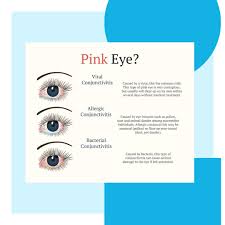 Image result for Viral Conjunctivitis